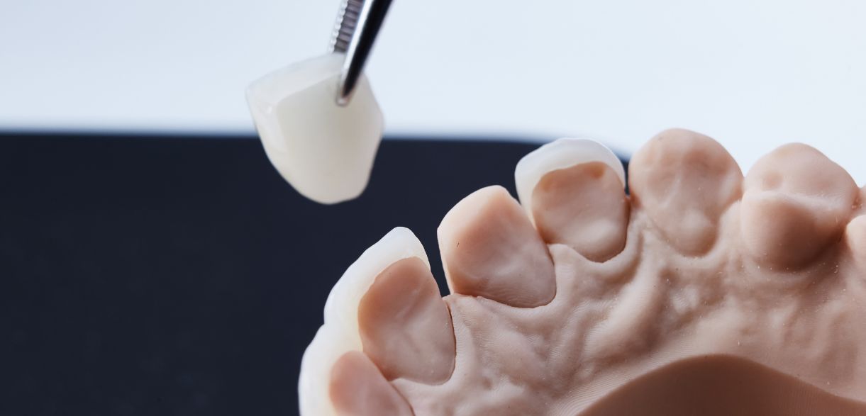 Caring for Your New Dental Veneers