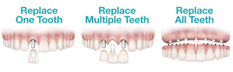 Dental Implant Replacement Options in Kyle TX
