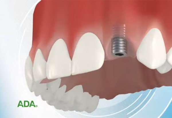 Dental Implants in Kyle TX - Dentist At Plum Creek Kyle
