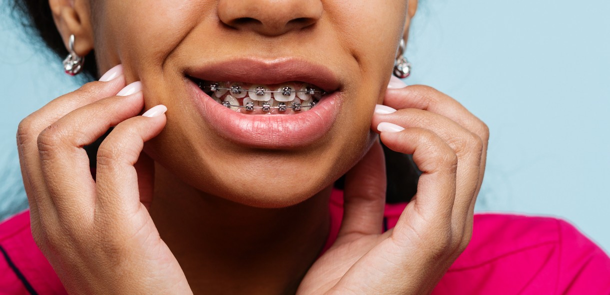 How To Whiten Teeth With Braces On - Dentist At Plum Creek Kyle