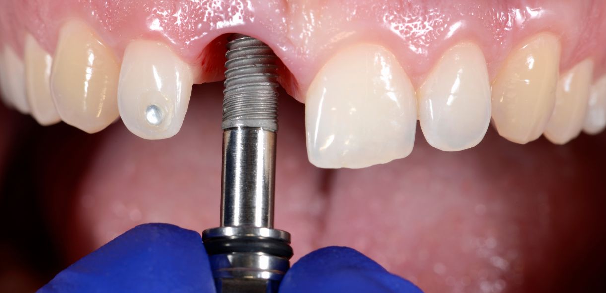 What to Know About Dental Implant Complications and Risks