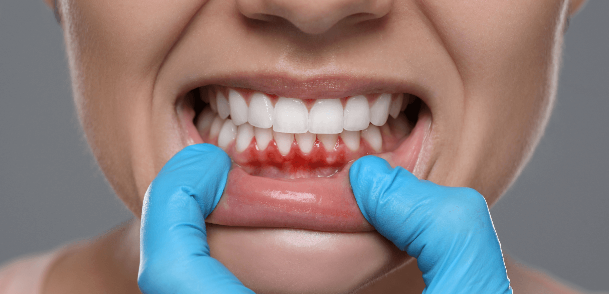 Immediate Actions for Bleeding Gums