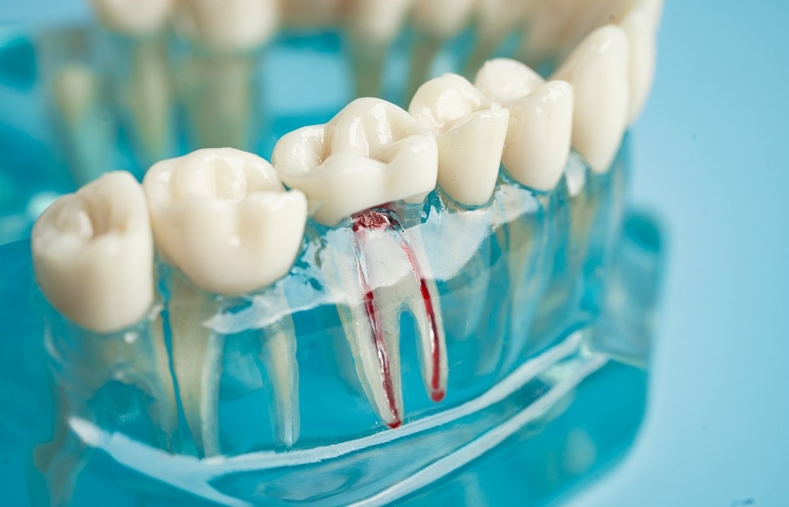 major signs and symptoms of a root canal