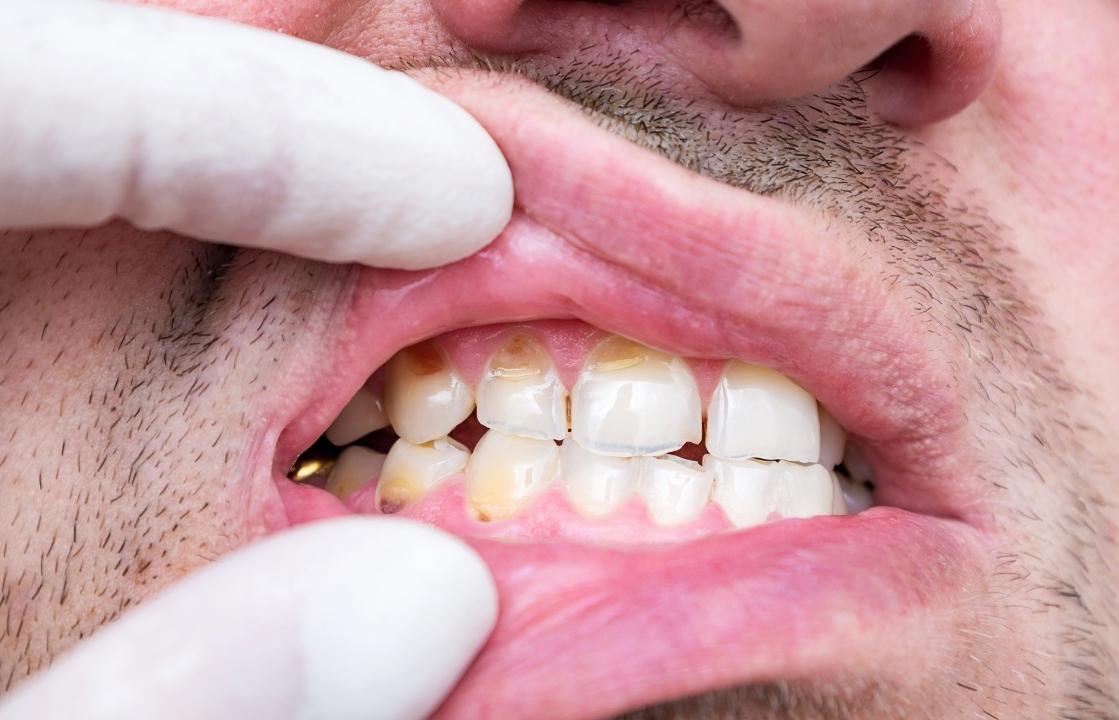 how a dentist can treat a chipped tooth to restore your smile