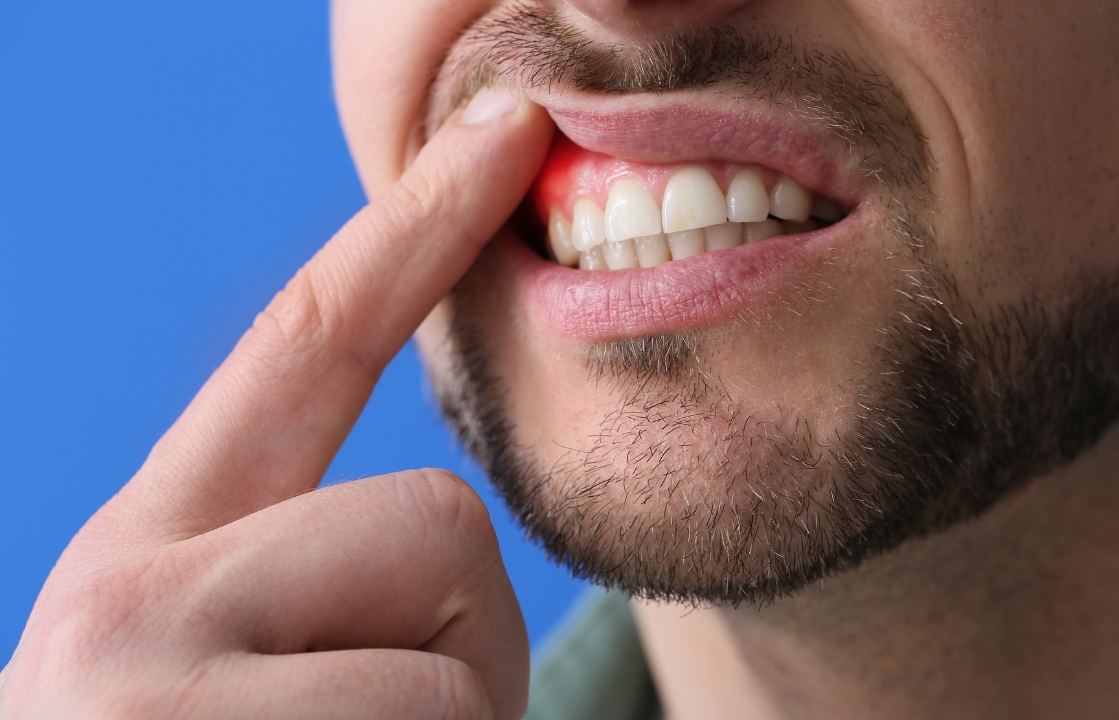 All About The Antibiotics Used In Gum Disease